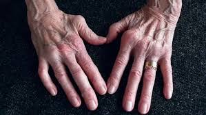 Rheumatoid Arthriris